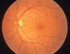 正常な網膜