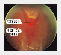 網膜裂孔とは？